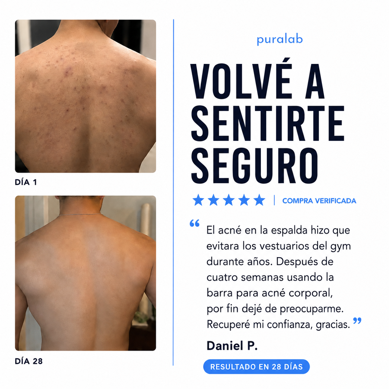 Puralab®  – Acné Corporal