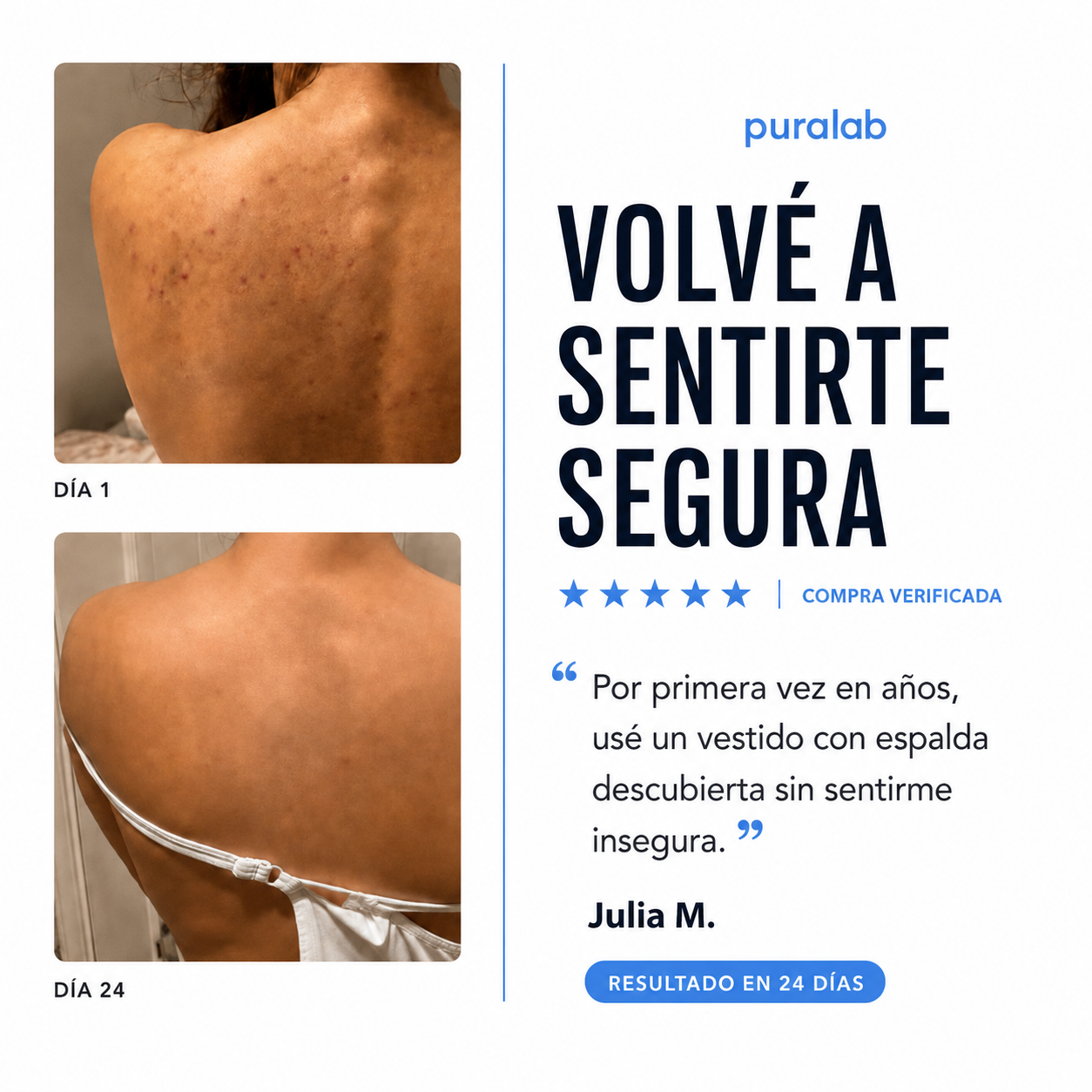 Puralab®  – Acné Corporal